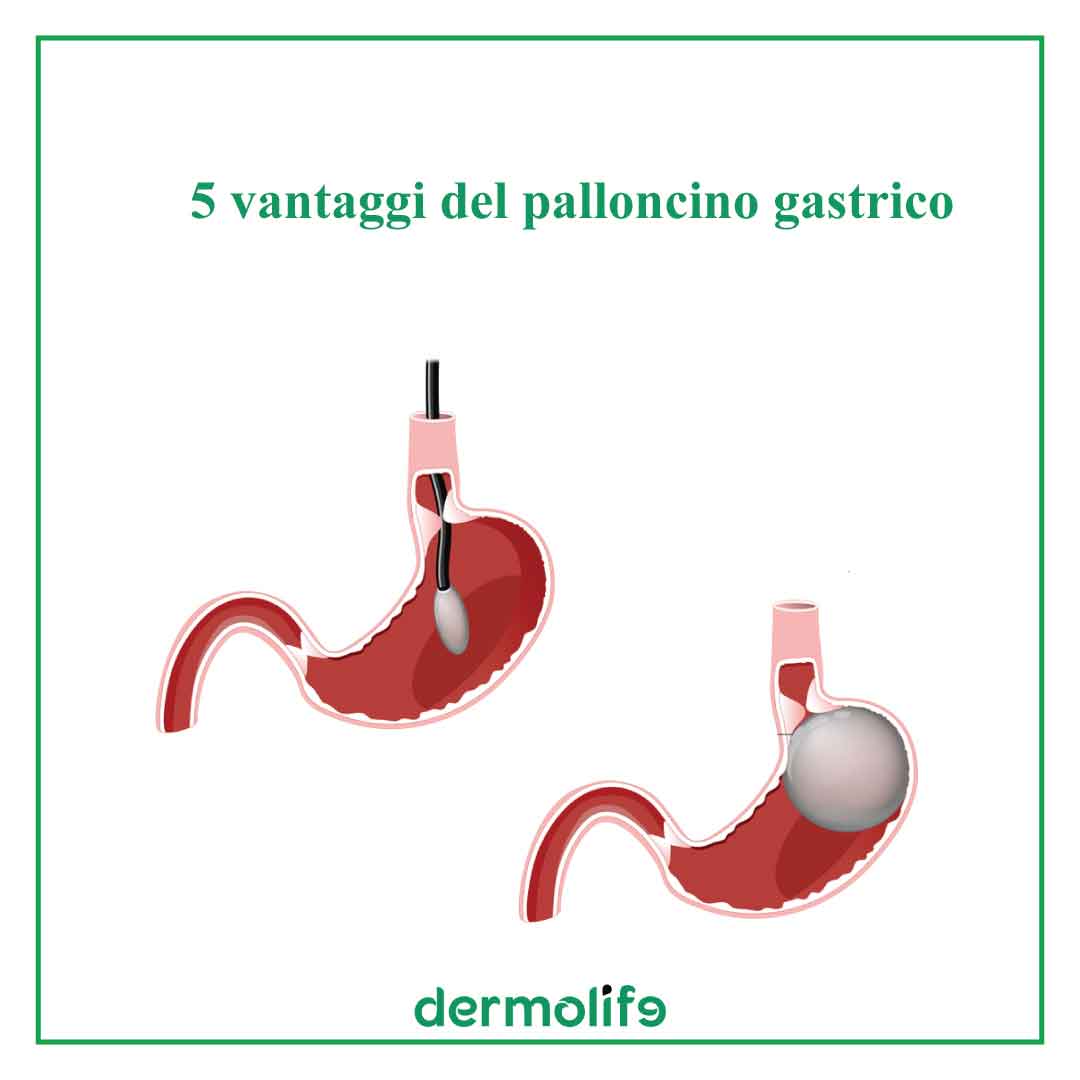 5 vantaggi palloncino gastrico