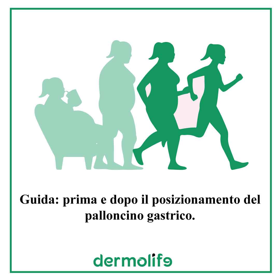 guida palloncino gastrico clinica dermolife