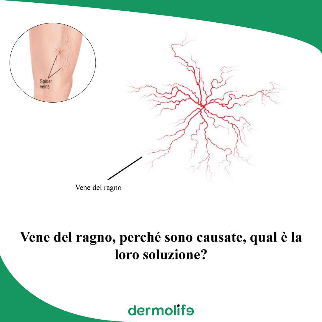 vene del ragno clinica