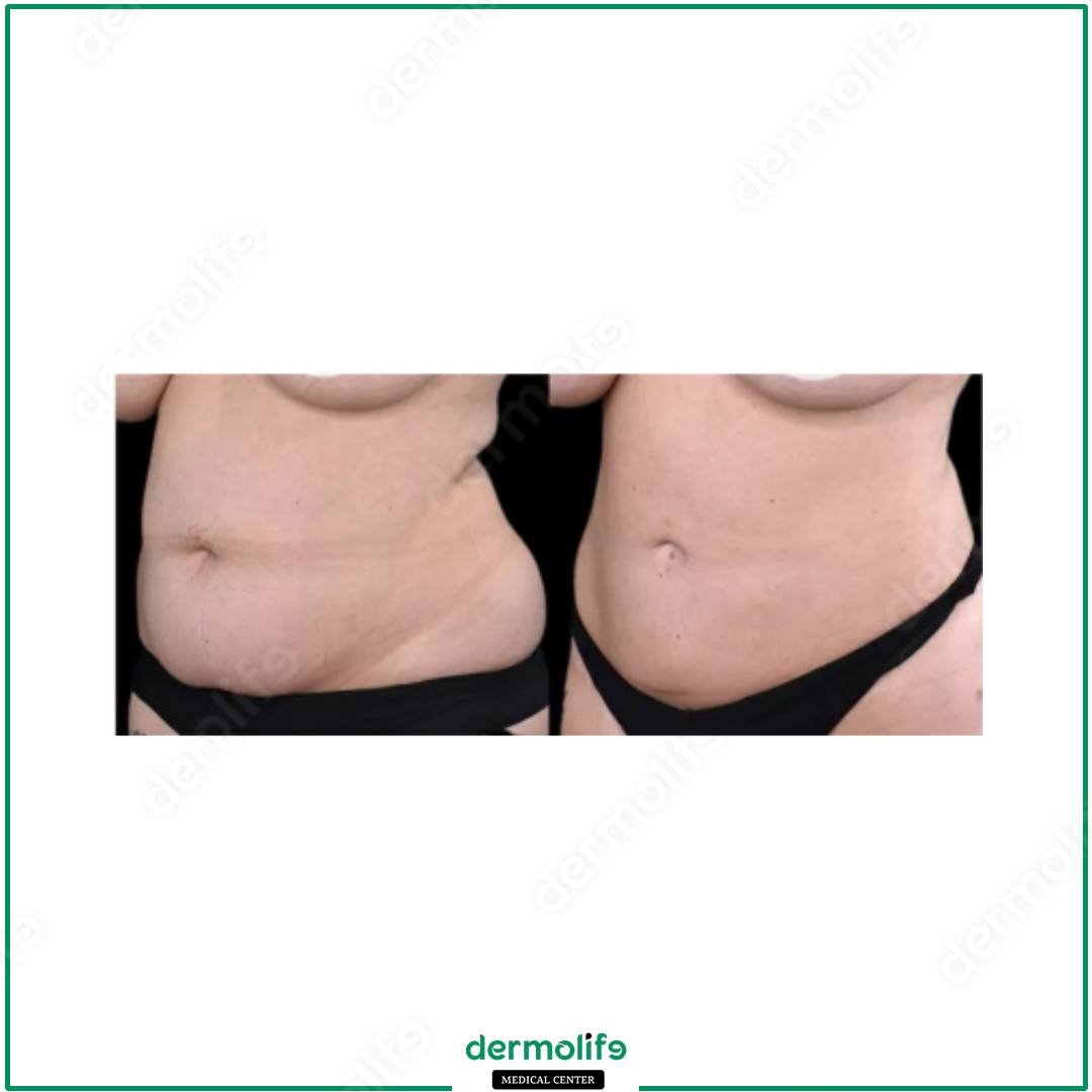 addominoplastica clinica estetica italy 