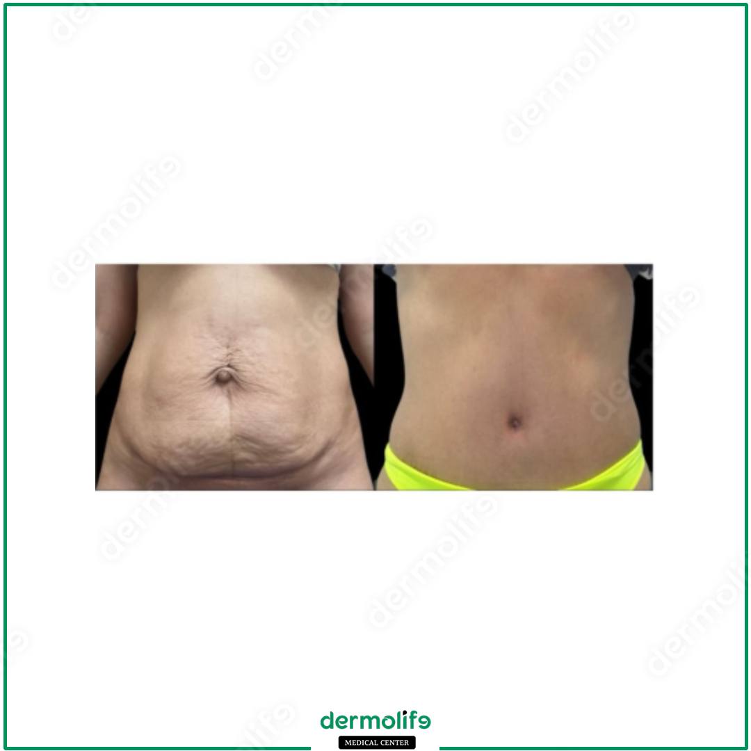 addominoplastica clinica estetica italy 