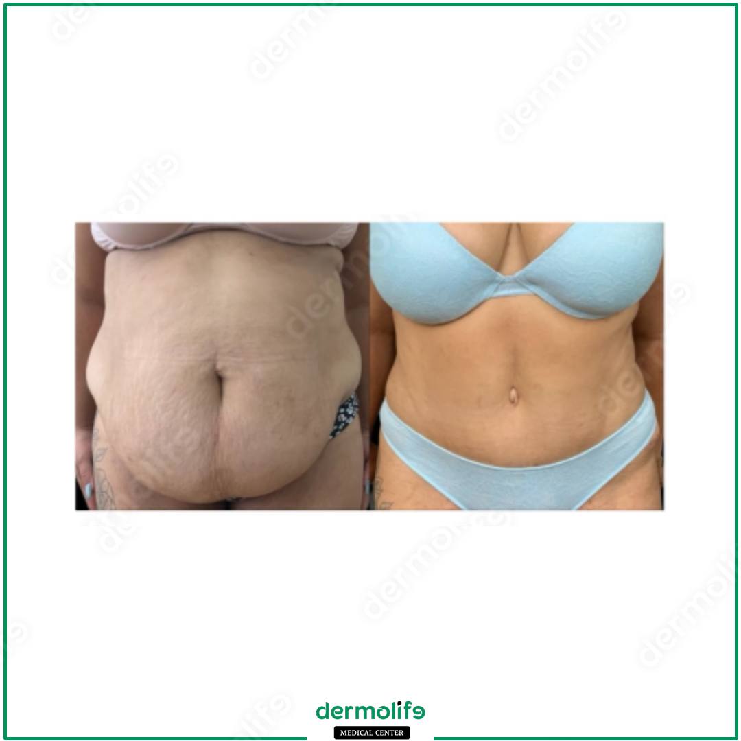 addominoplastica clinica estetica italy 