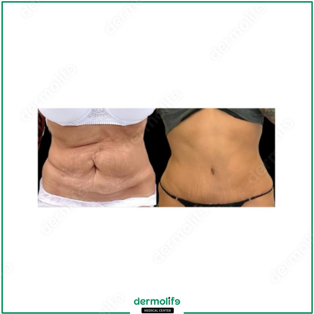 addominoplastica clinica estetica italy 