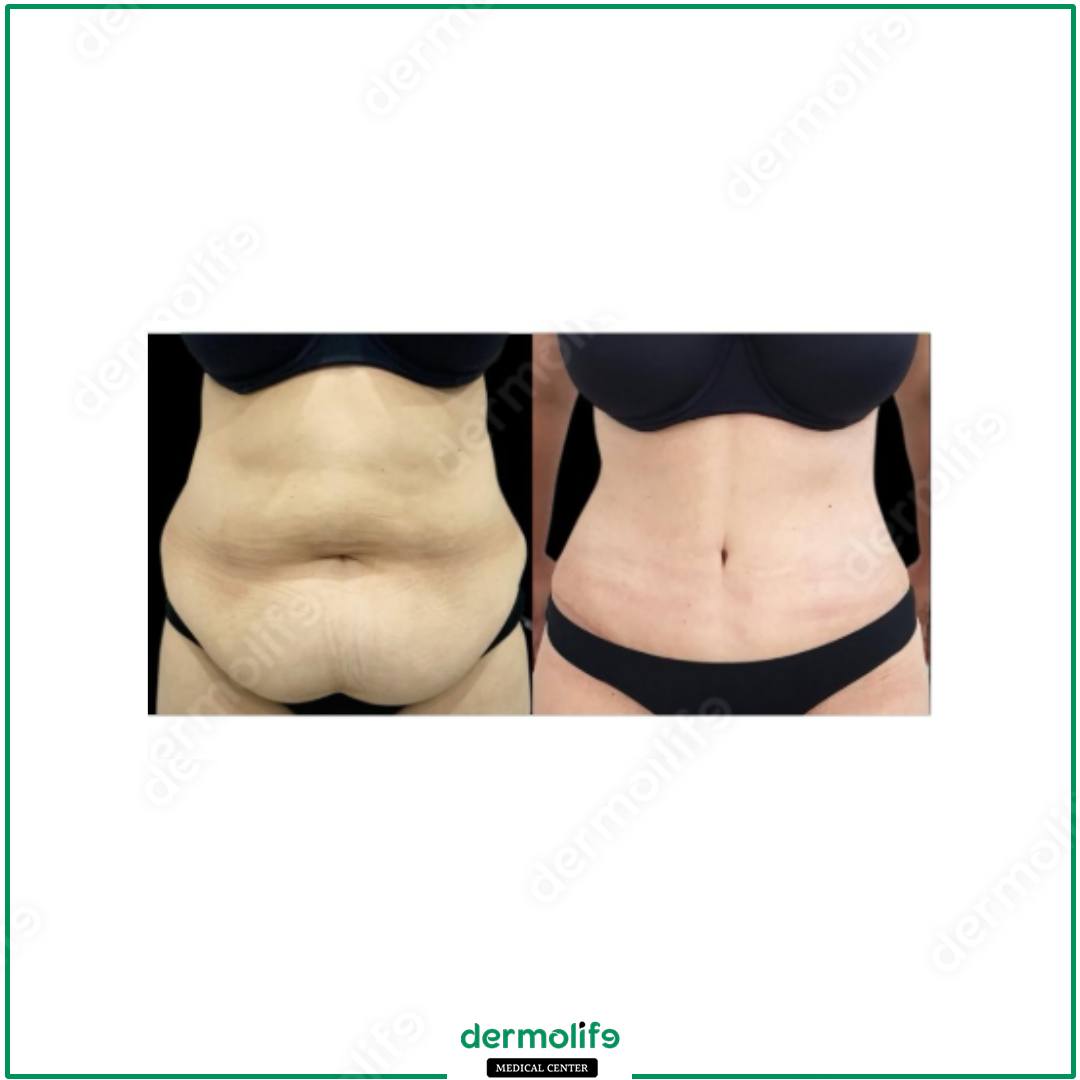 addominoplastica clinica estetica italy 