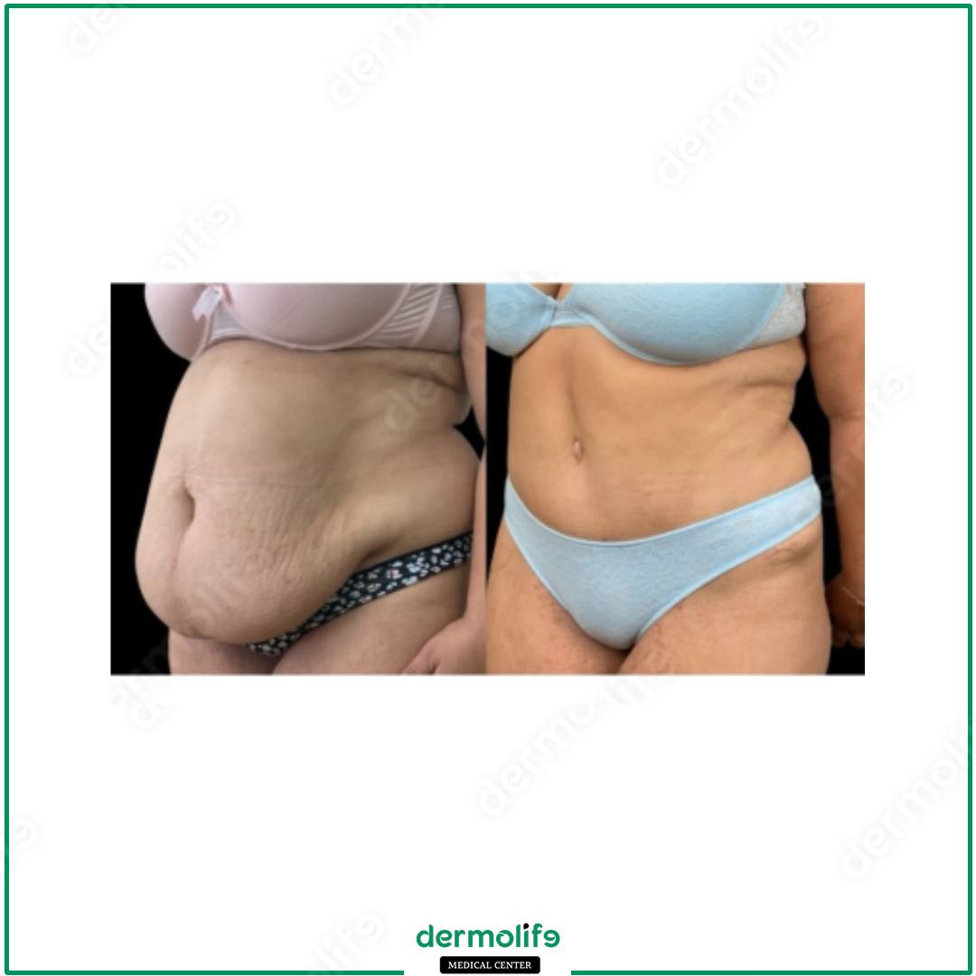 addominoplastica clinica estetica italy 