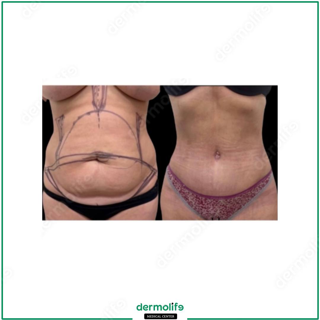 addominoplastica clinica estetica italy 