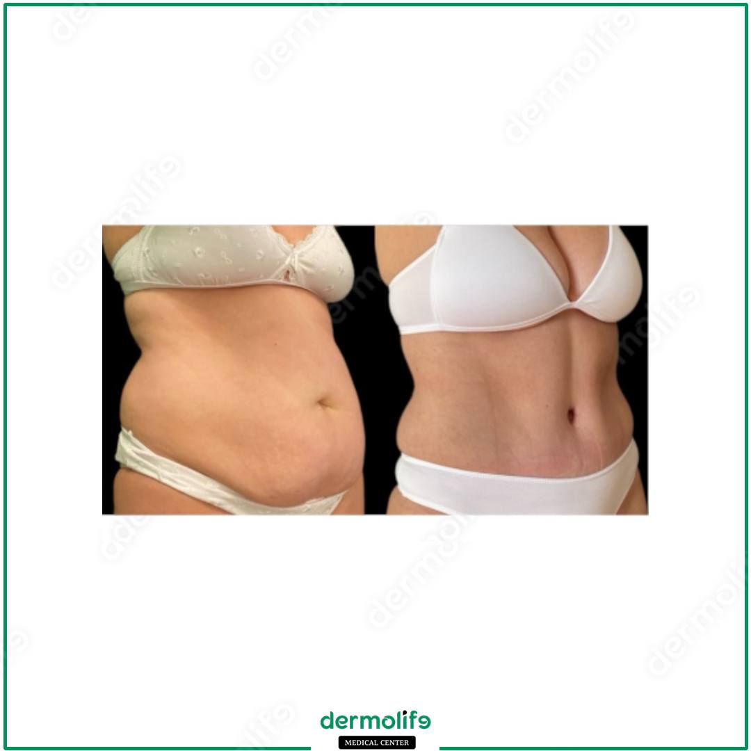 addominoplastica clinica estetica italy 