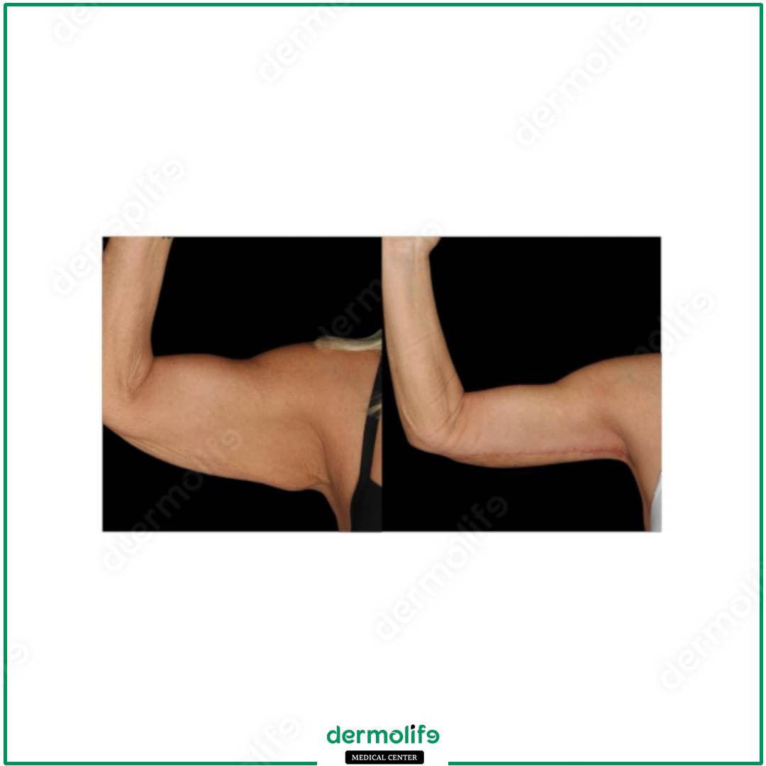braccia clinica estetica italy 
