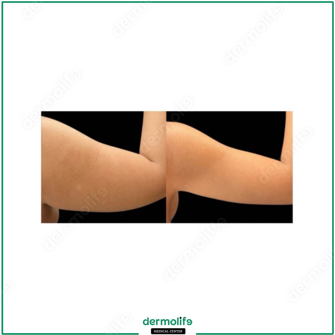 braccia clinica estetica italy 