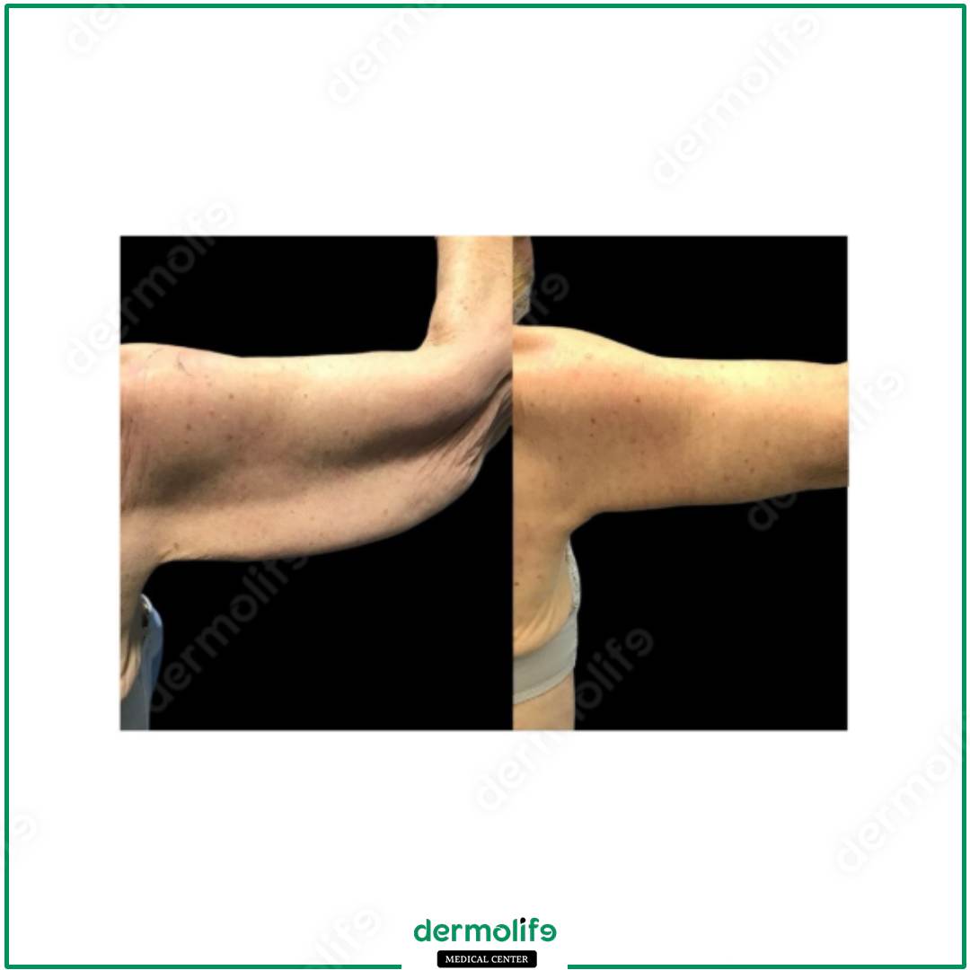 braccia clinica estetica italy 