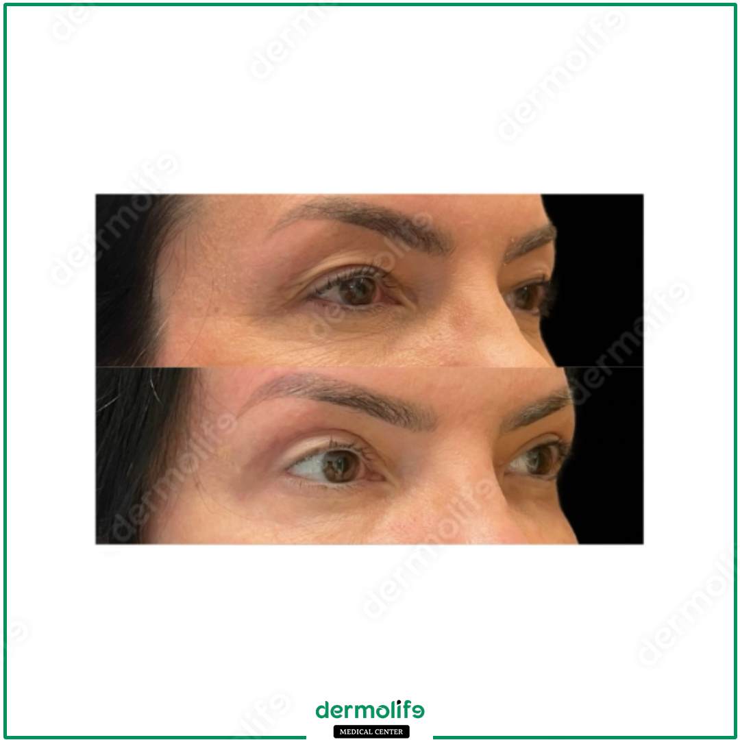 blefaroplastica clinica estetica italy 