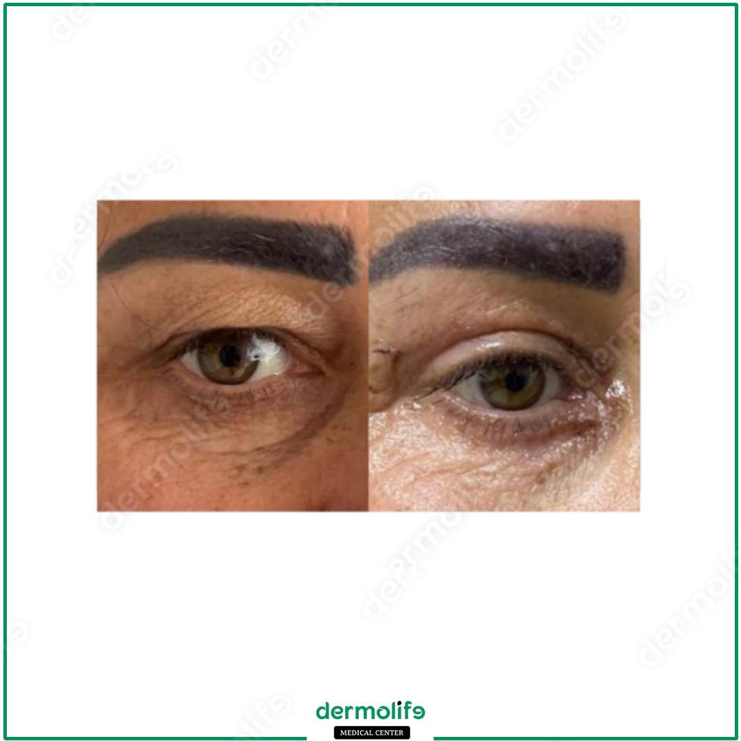 blefaroplastica clinica estetica italy 