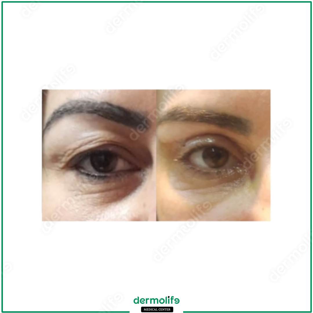 blefaroplastica clinica estetica italy 