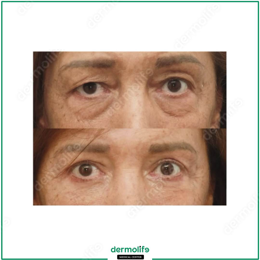 blefaroplastica clinica estetica italy 