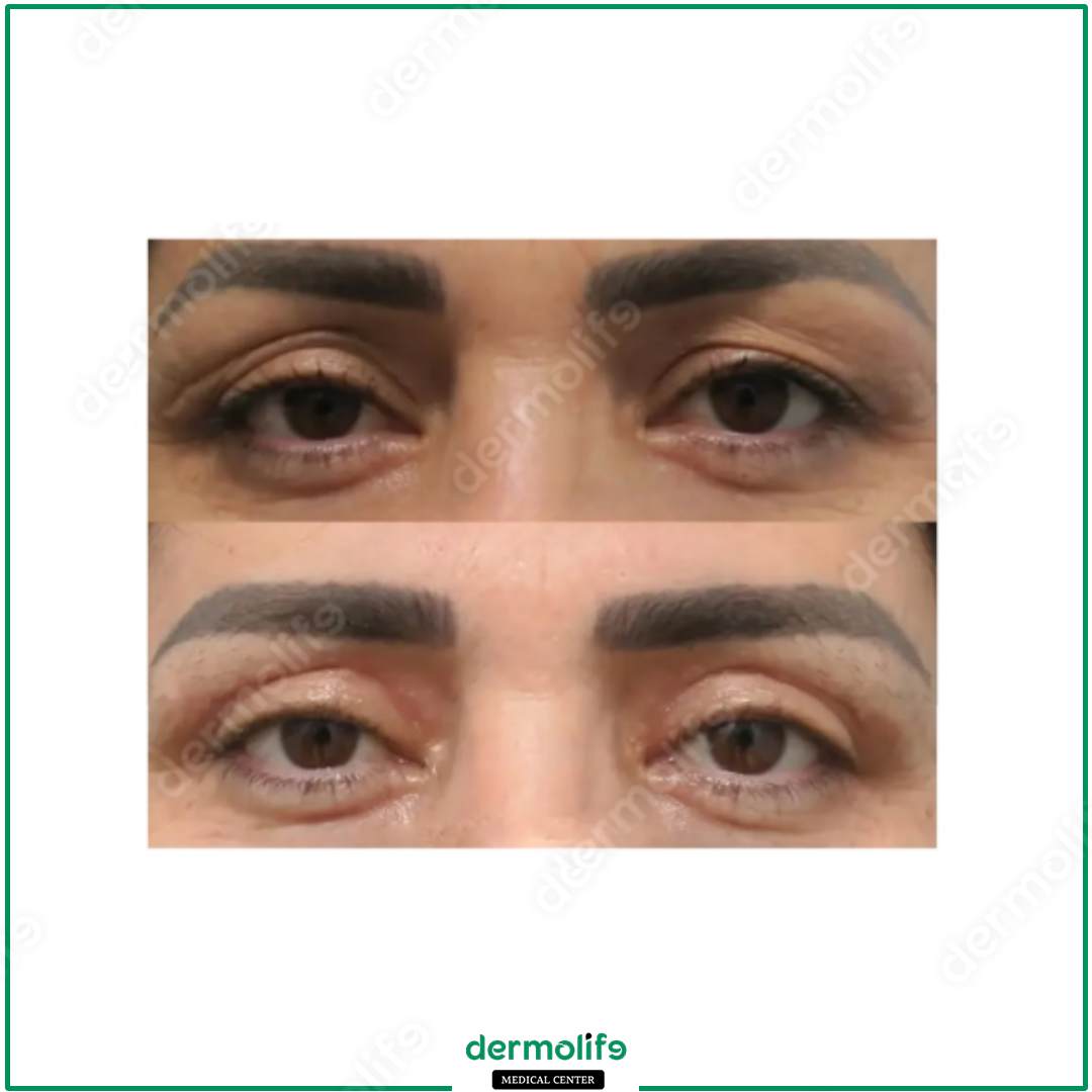 blefaroplastica clinica estetica italy 