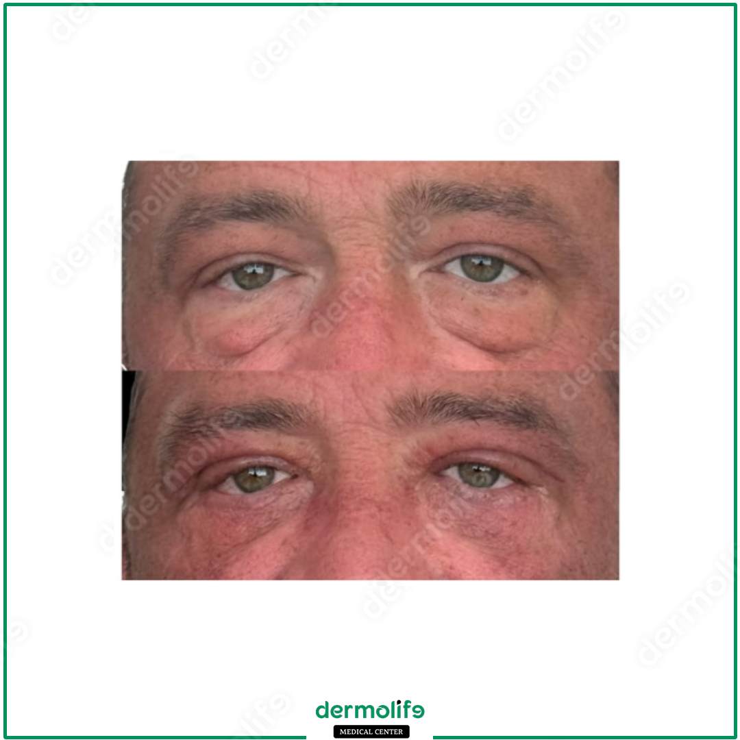 blefaroplastica clinica estetica italy 