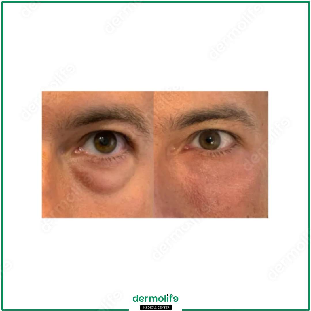 blefaroplastica clinica estetica italy 