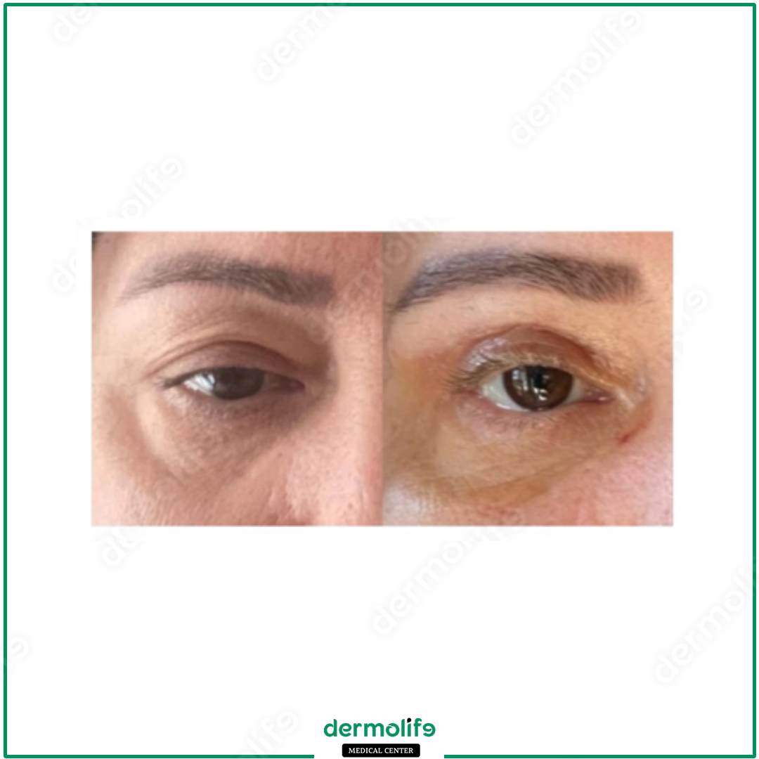 blefaroplastica clinica estetica italy 