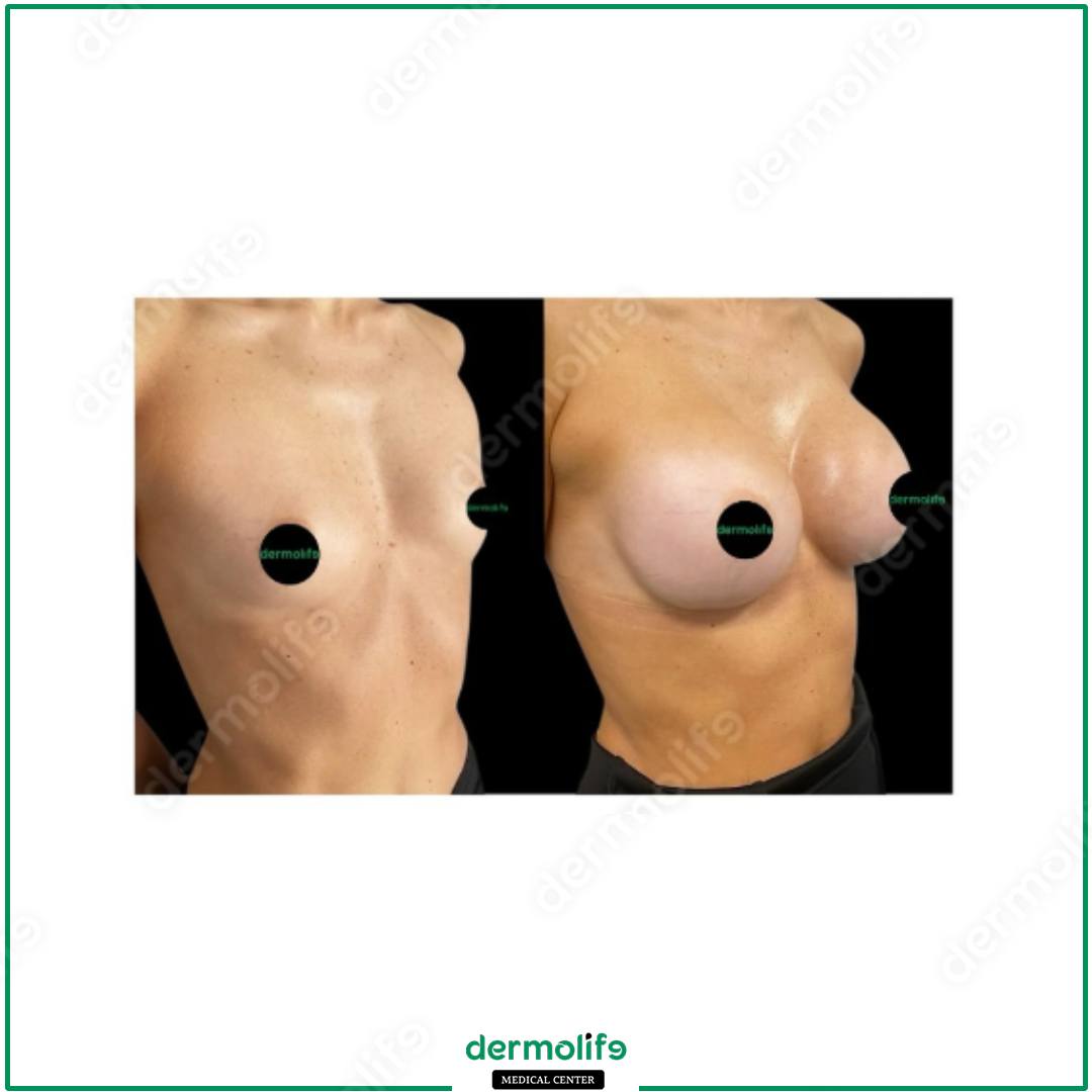 mastopessi clinica estetica italy 