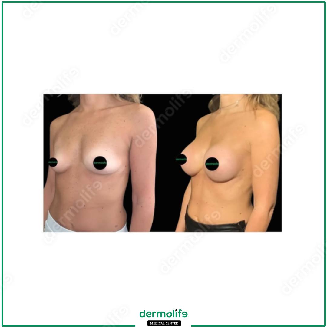 mastopessi clinica estetica italy 