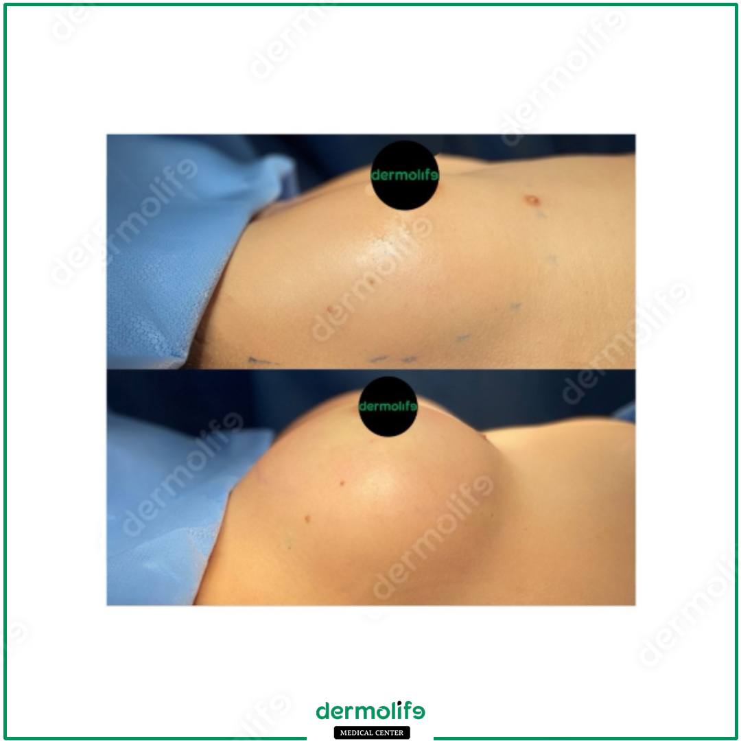 mastopessi clinica estetica italy 