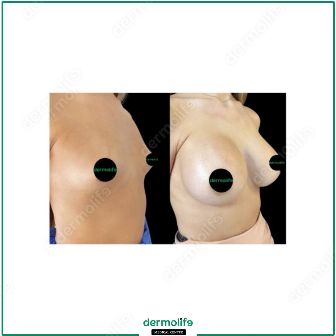 mastopessi clinica estetica italy 