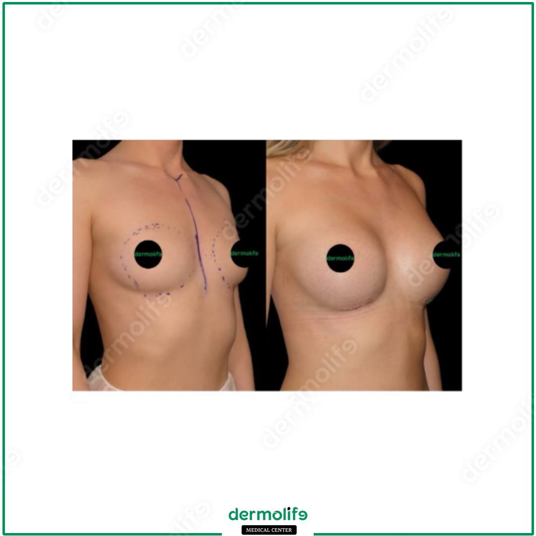 mastopessi clinica estetica italy 