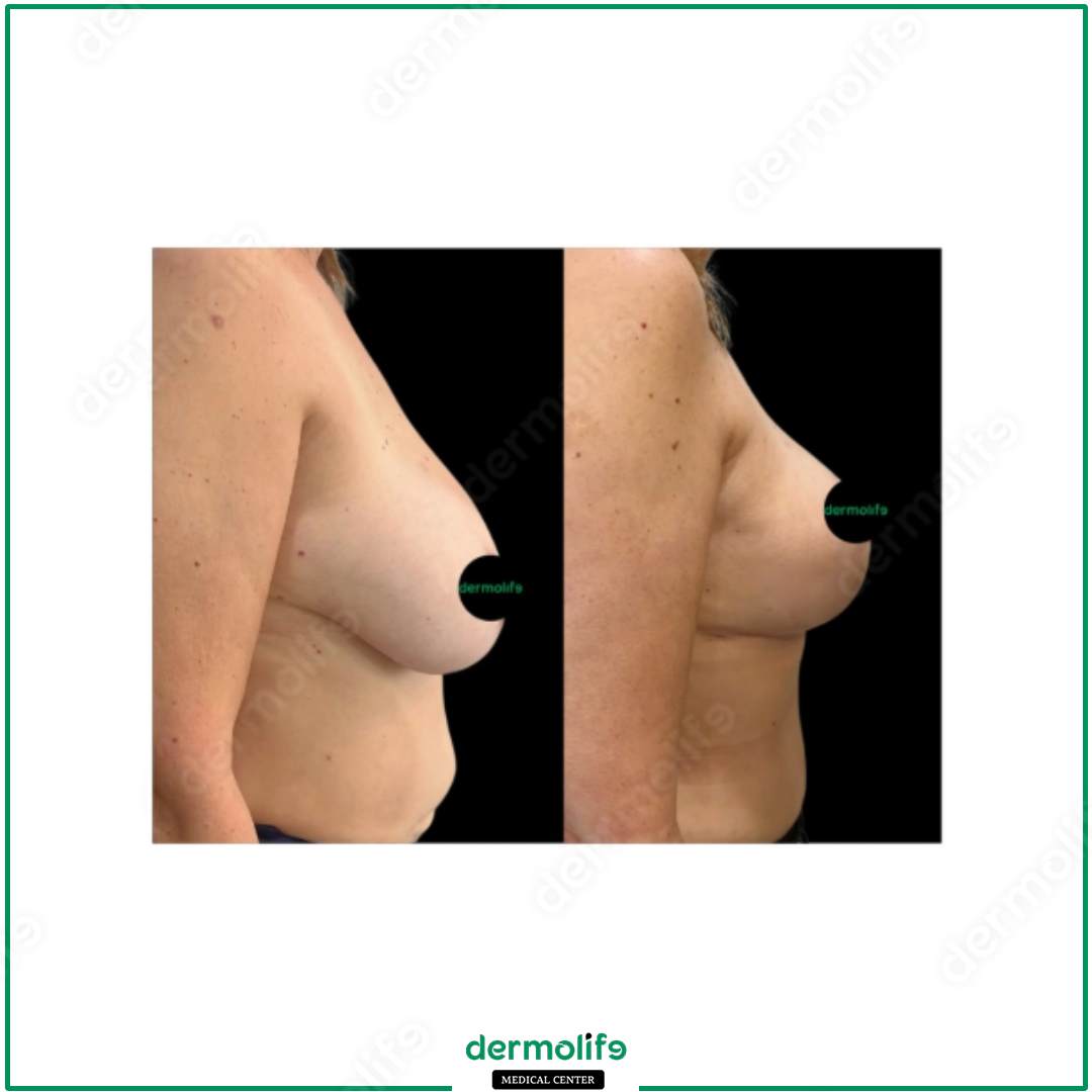 lifting del seno clinica estetica italy 