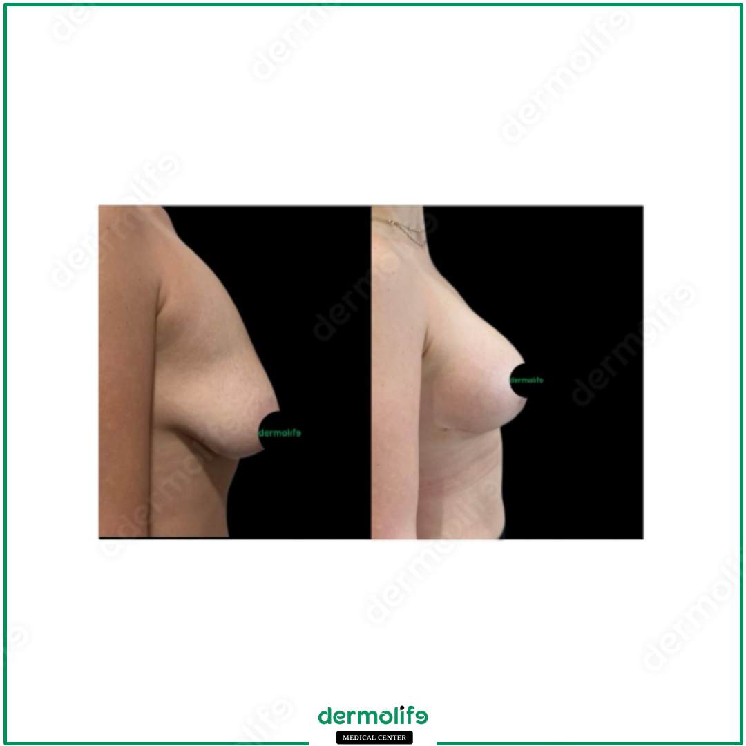 lifting del seno clinica estetica italy 
