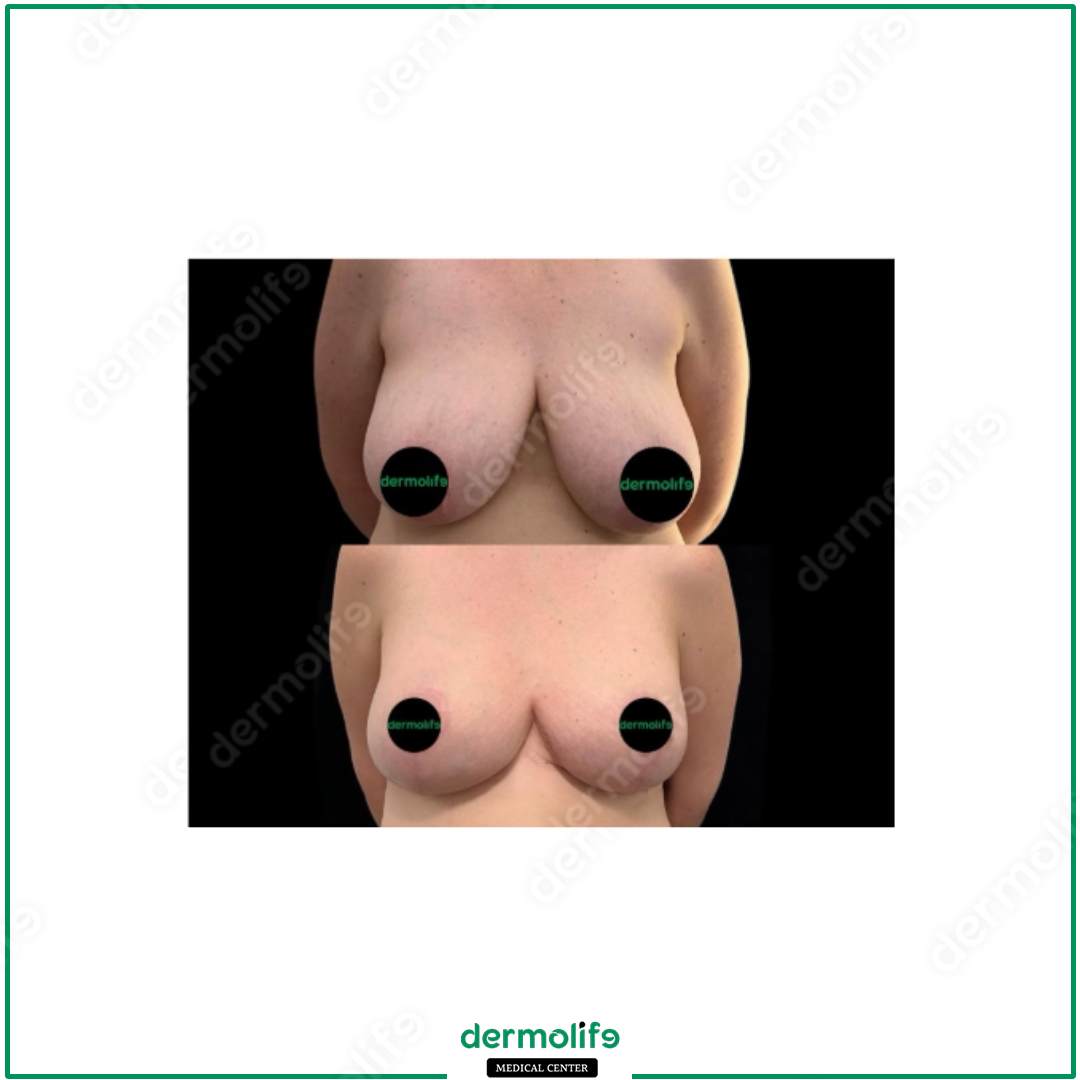 lifting del seno clinica estetica italy 