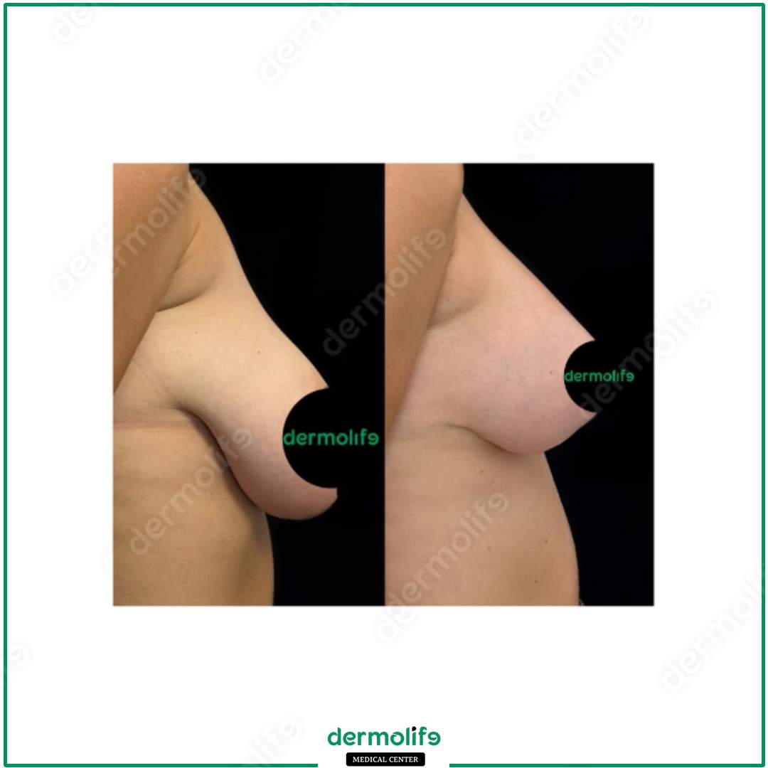 riduzione del seno clinica estetica italy 