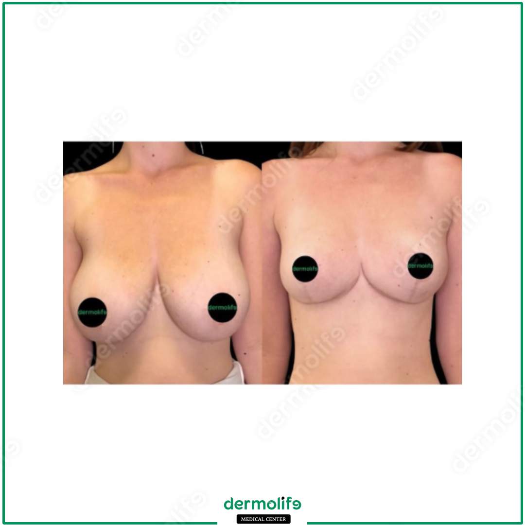 riduzione del seno clinica estetica italy 