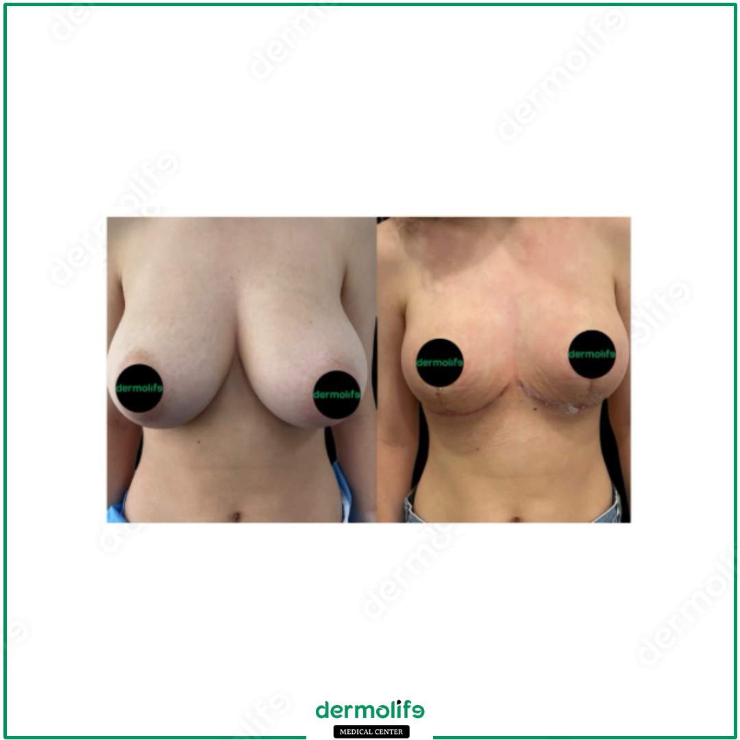riduzione del seno clinica estetica italy 