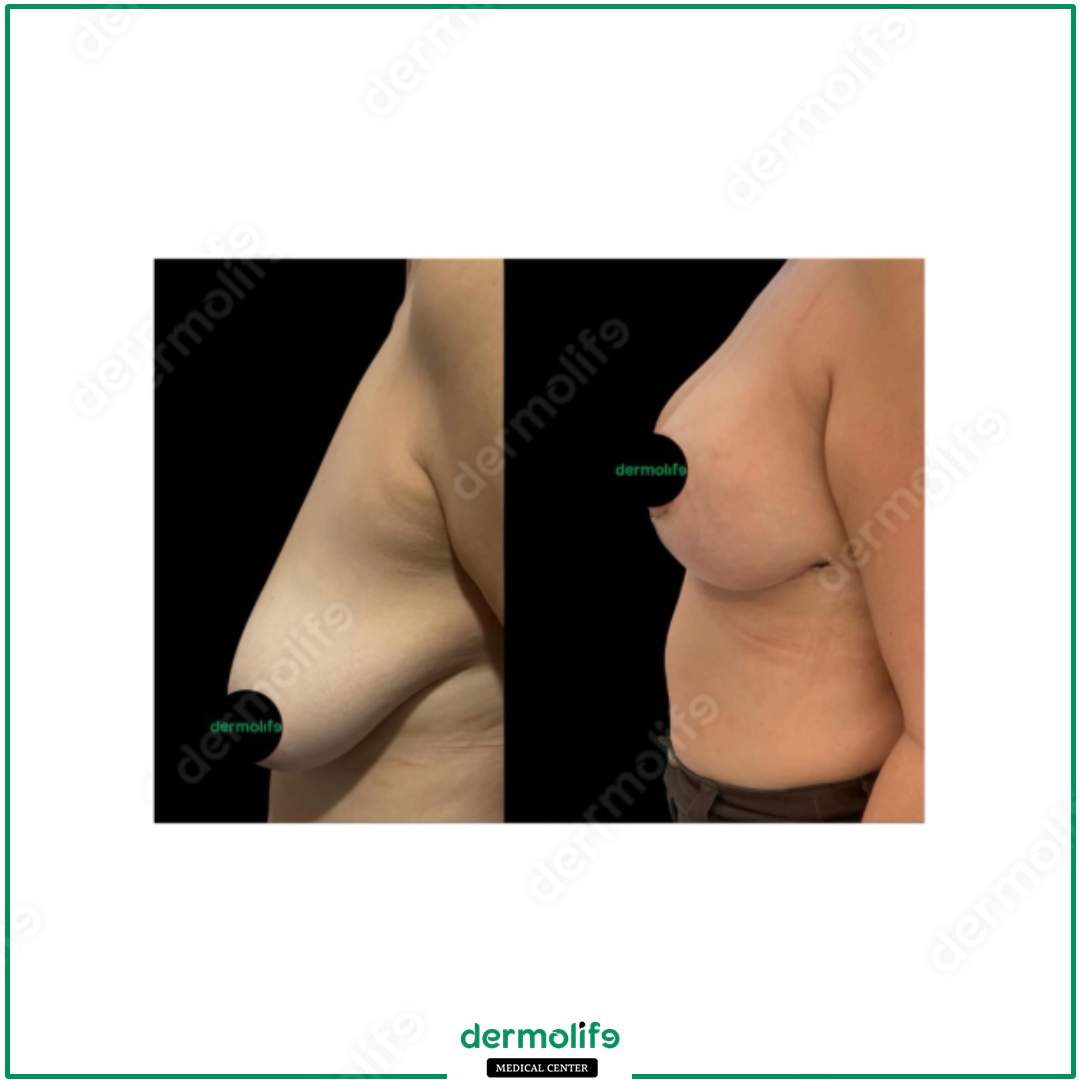 riduzione del seno clinica estetica italy 