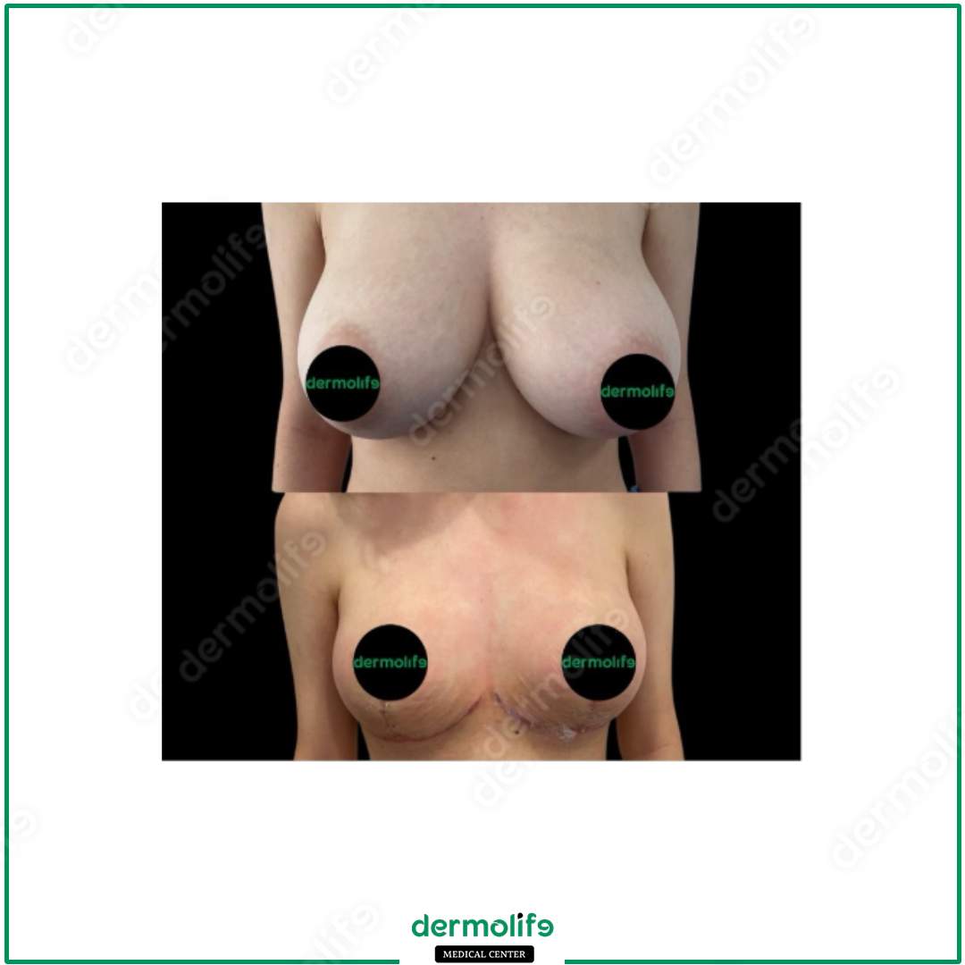 riduzione del seno clinica estetica italy 