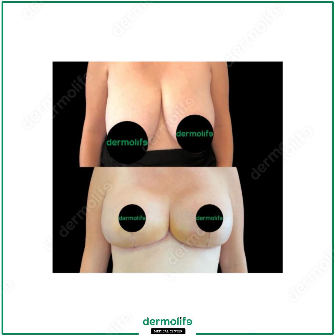 riduzione del seno clinica estetica italy 