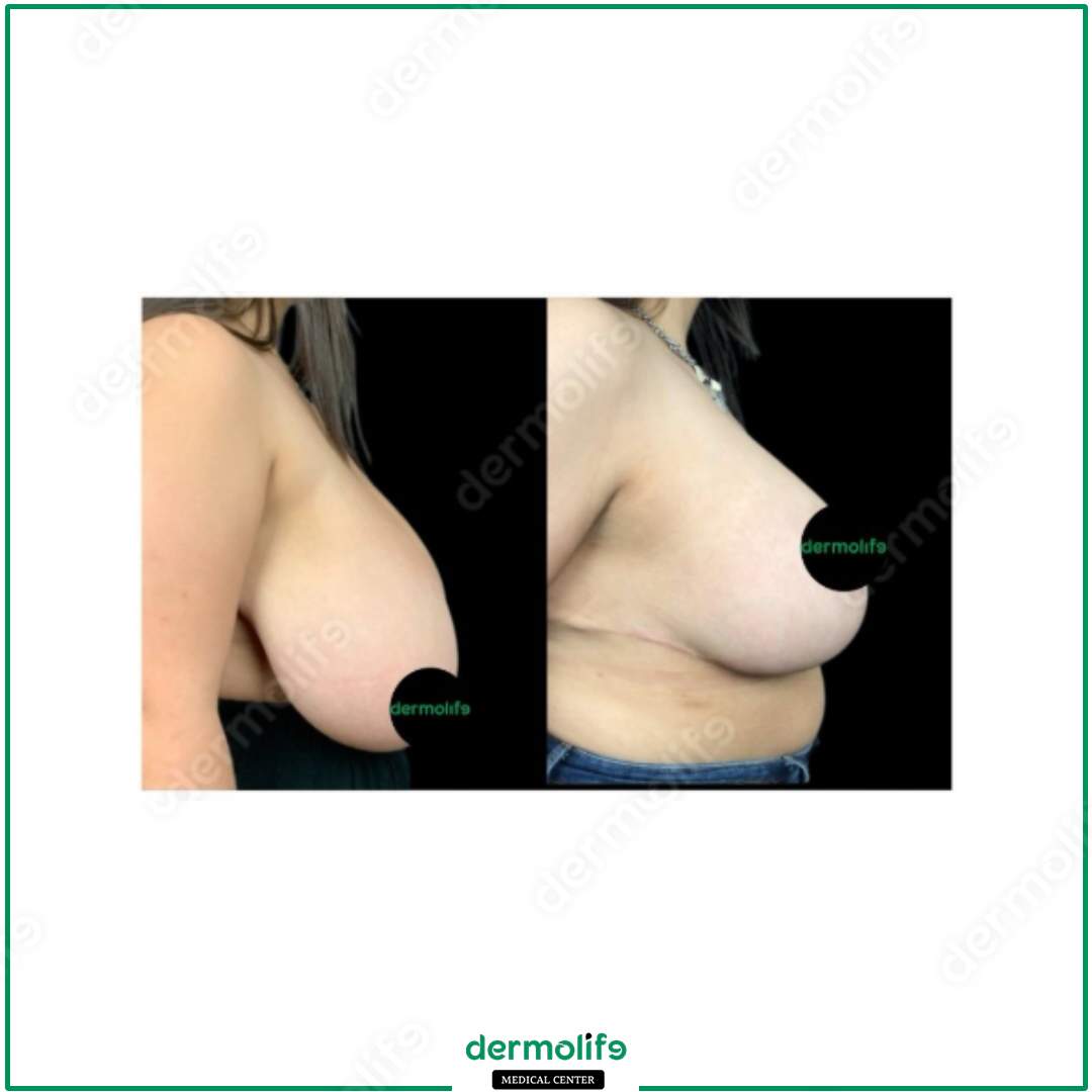 riduzione del seno clinica estetica italy 