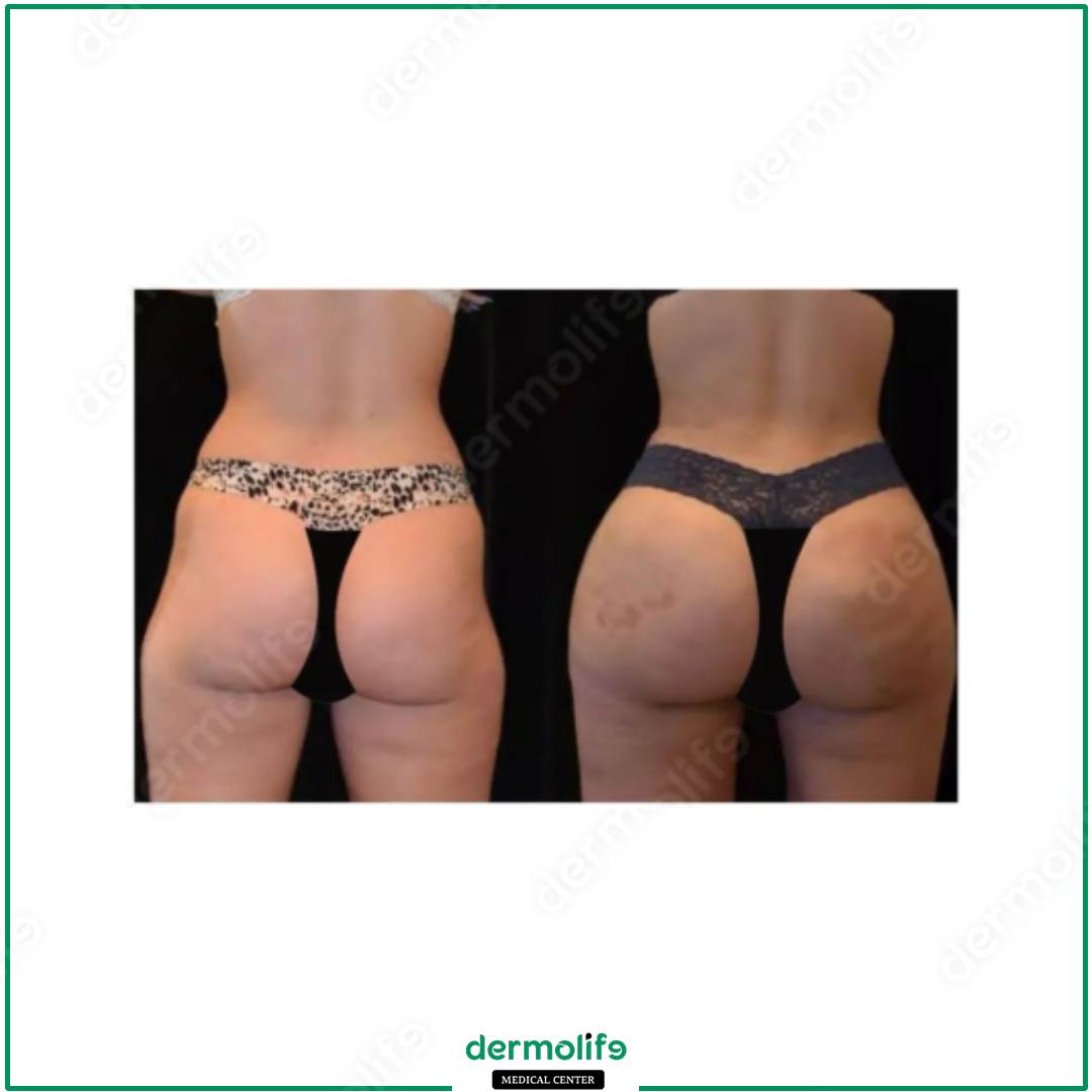 gluteoplastica clinica estetica italy 