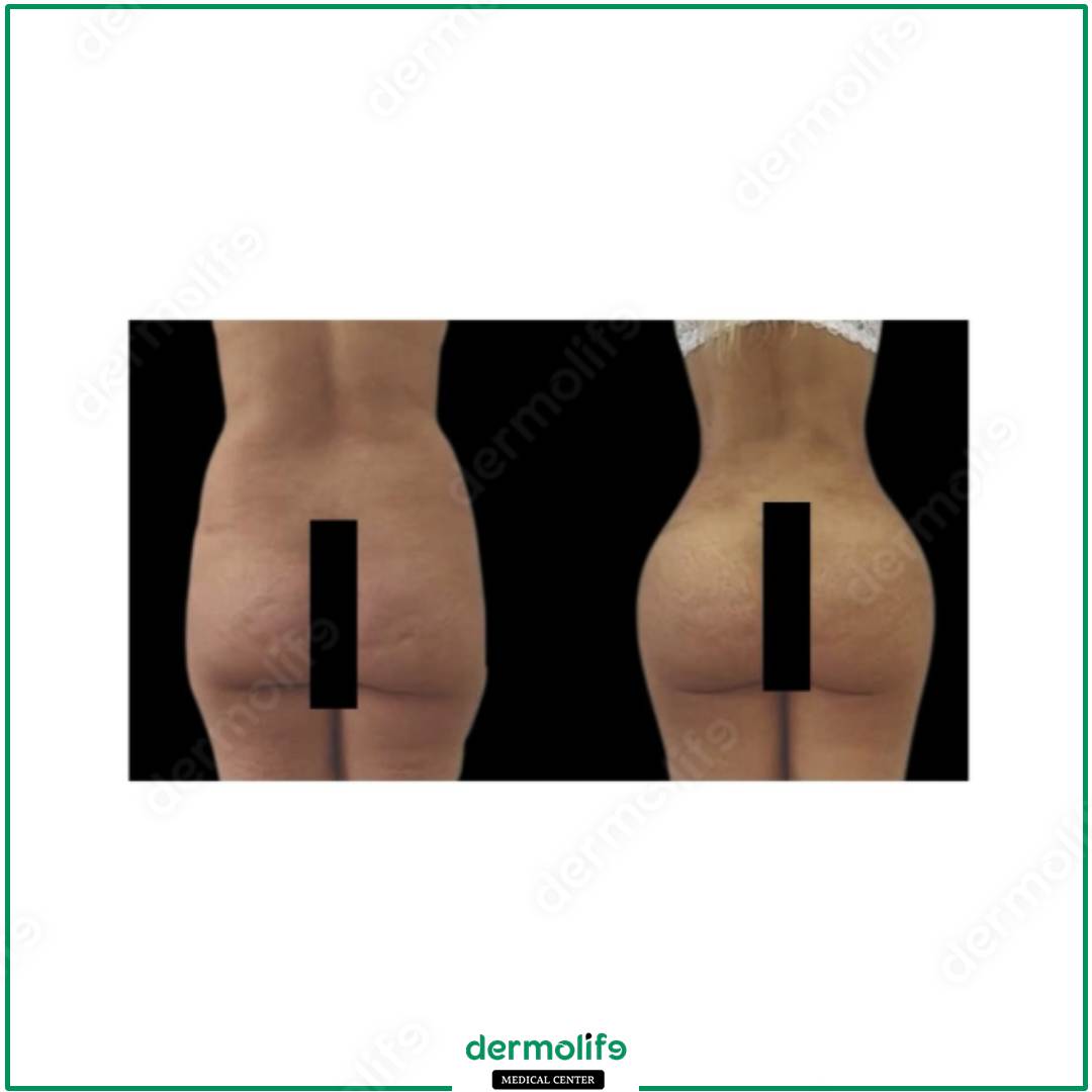 gluteoplastica clinica estetica italy 