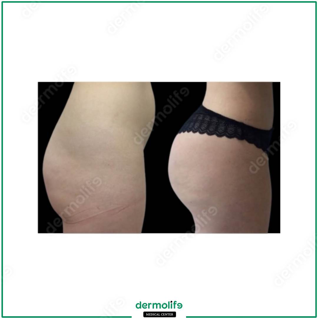 gluteoplastica clinica estetica italy 