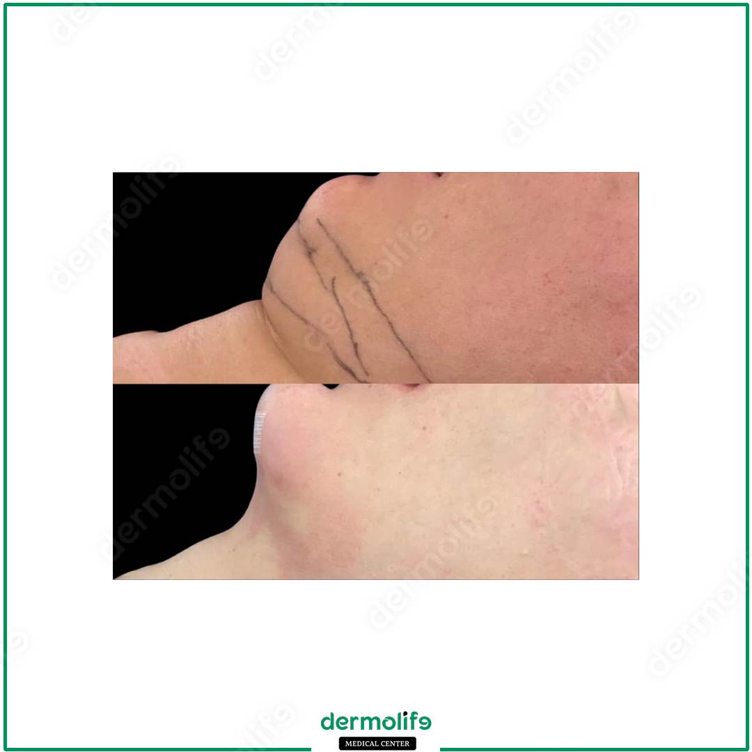 rimodellamento del mento clinica estetica italy 