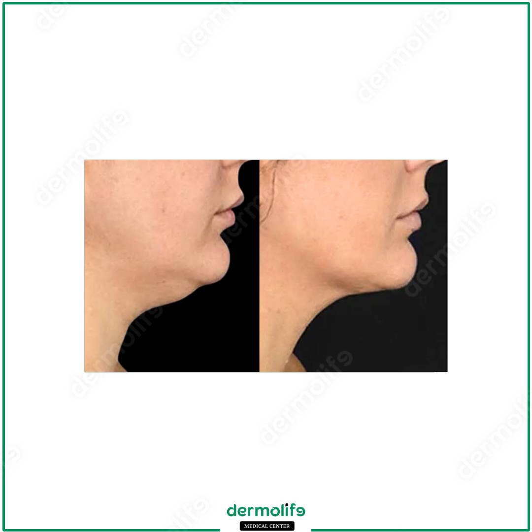 rimodellamento del mento clinica estetica italy 