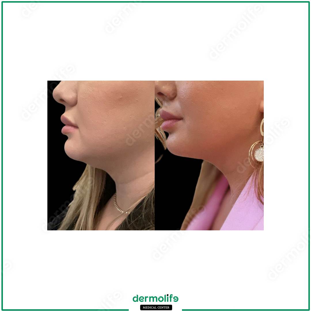 rimodellamento del mento clinica estetica italy 