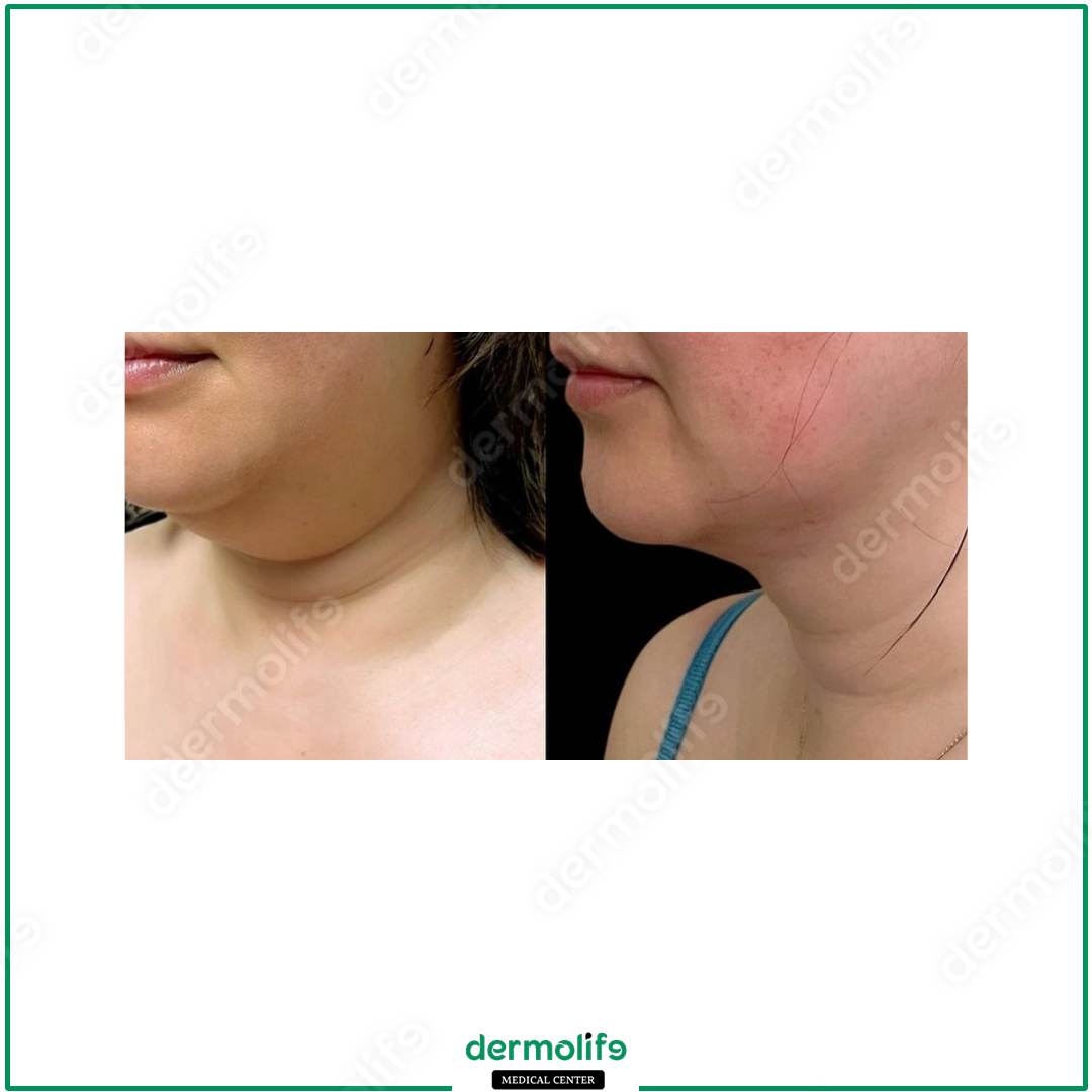 rimodellamento del mento clinica estetica italy 