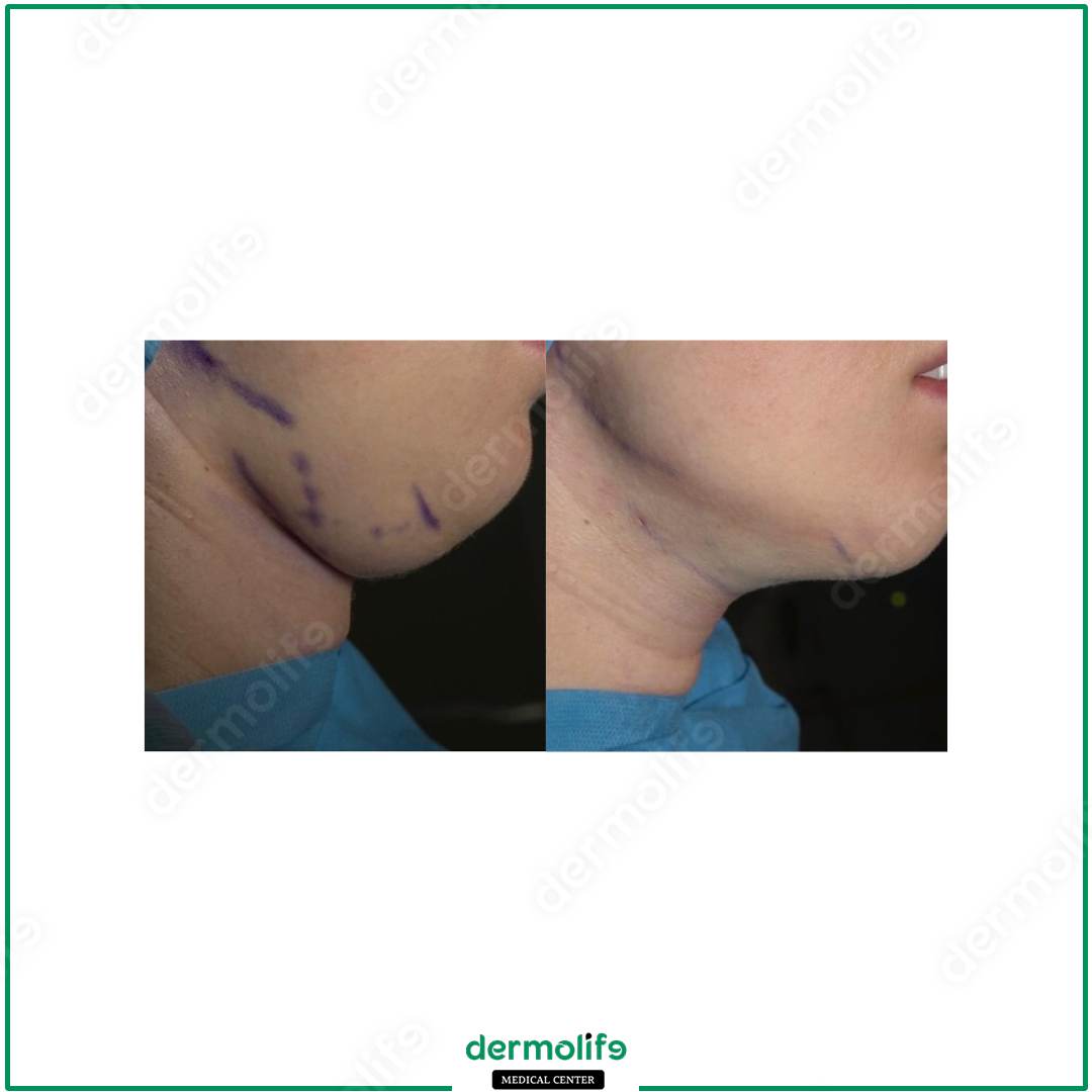rimodellamento del mento clinica estetica italy 