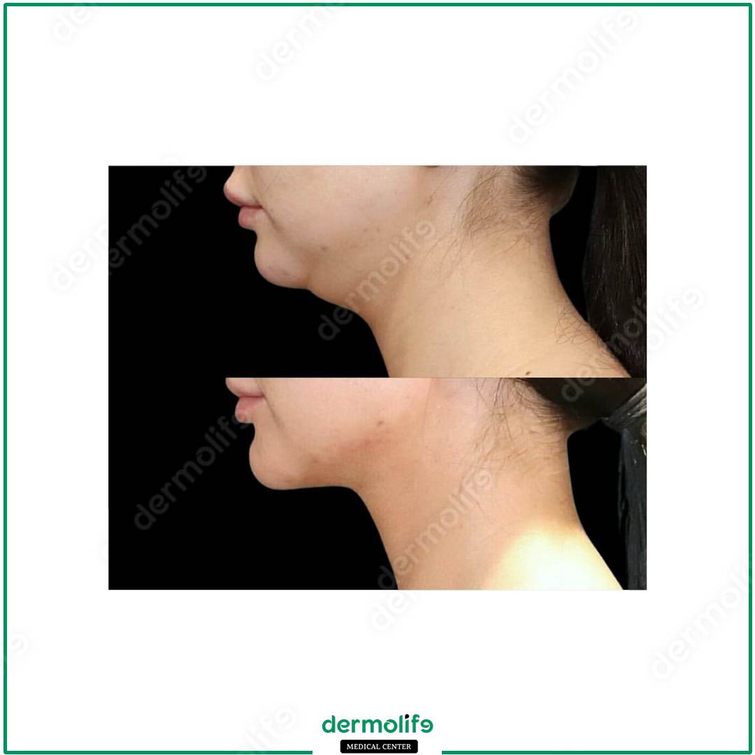 rimodellamento del mento clinica estetica italy 