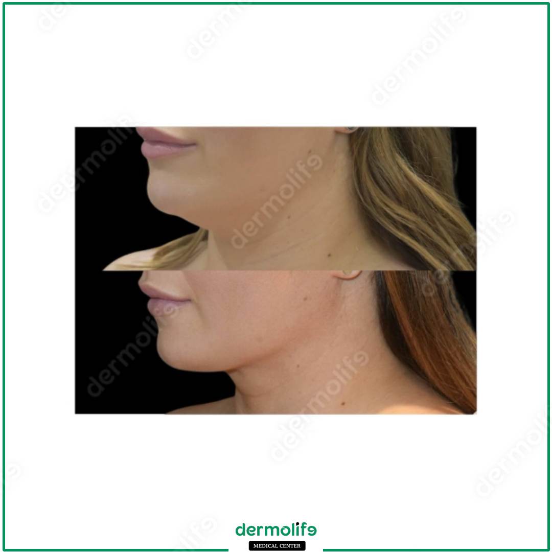 rimodellamento del mento clinica estetica italy 