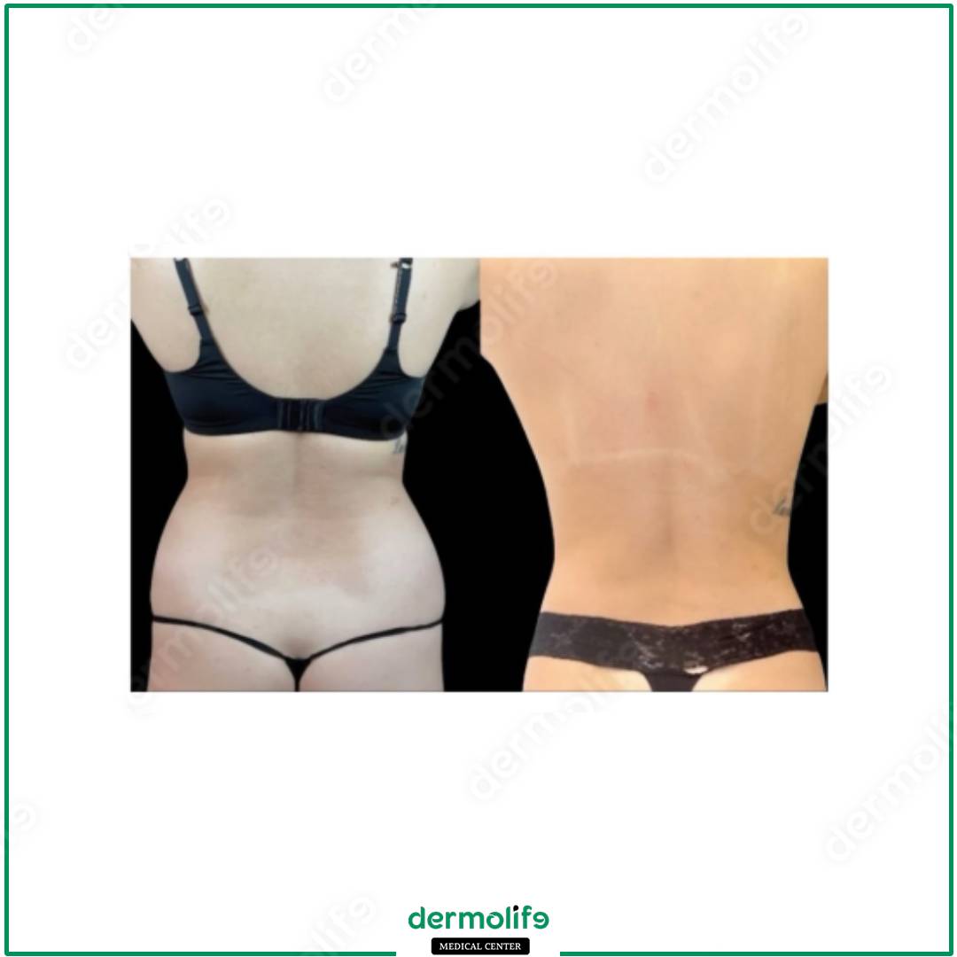 liposuzione clinica estetica italy 