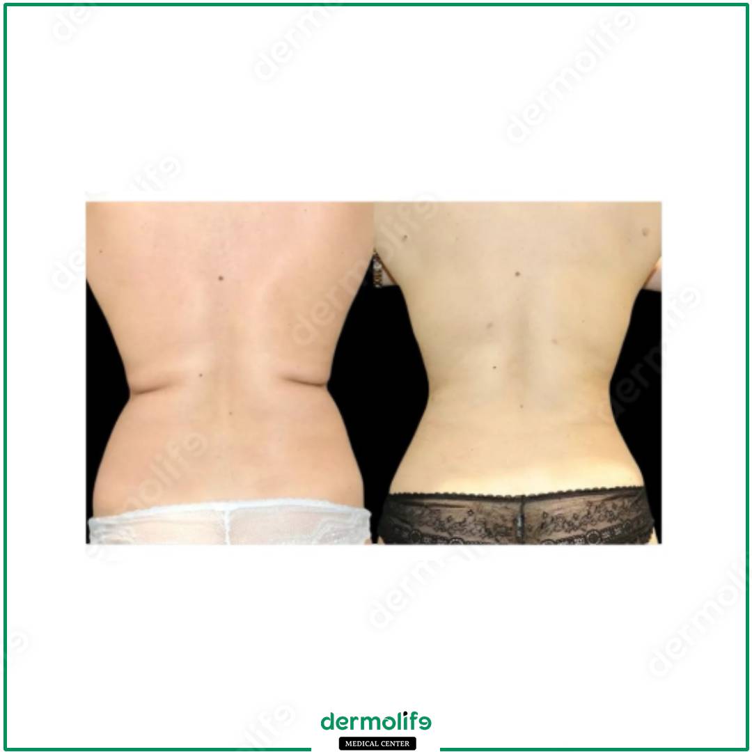 liposuzione clinica estetica italy 