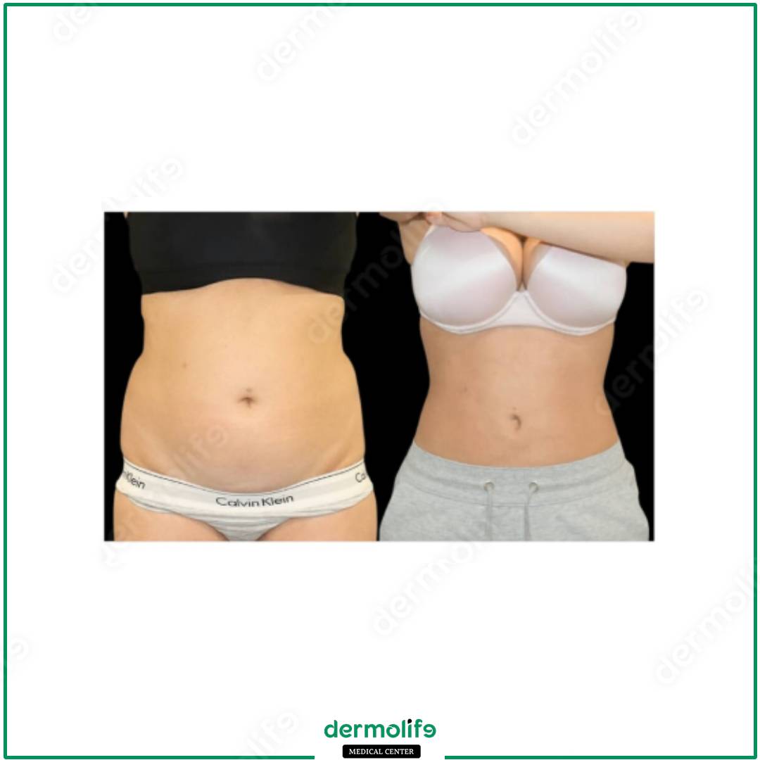 liposuzione clinica estetica italy 
